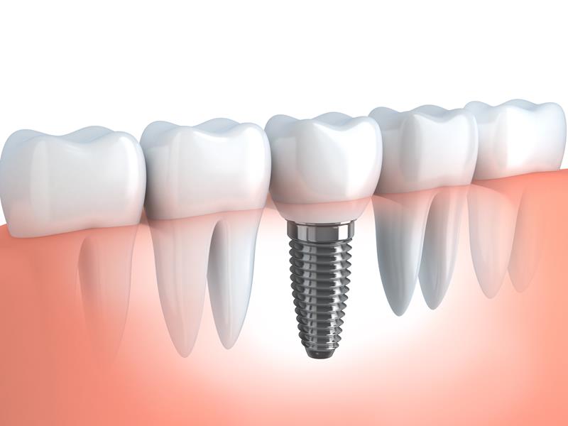 Dental Implants  Baja California, Mexico